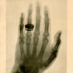 x-ray of a hand wearing a ring